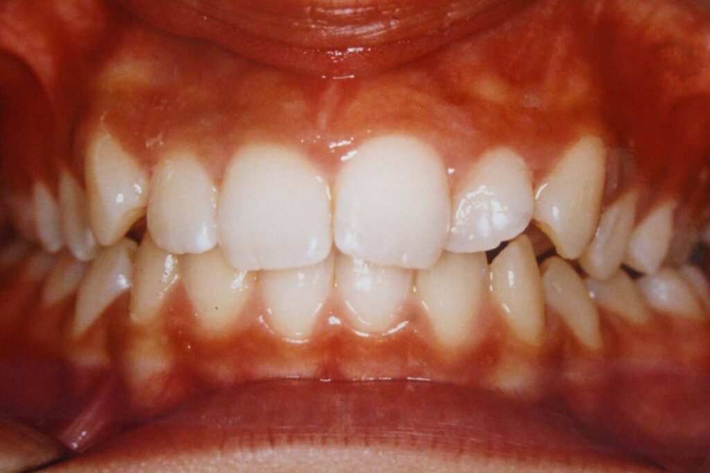 Dientes antes de hacer la ortodoncia