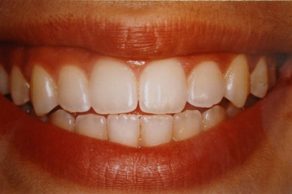Dientes después de la ortodoncia