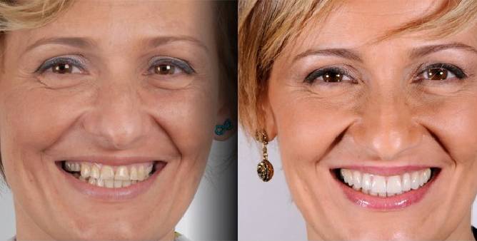 Antes y después de tratamiento de estética dental