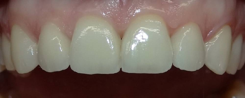 Después de hacer el tratamiento de ortodoncia invisible y rehabilitación estética dental