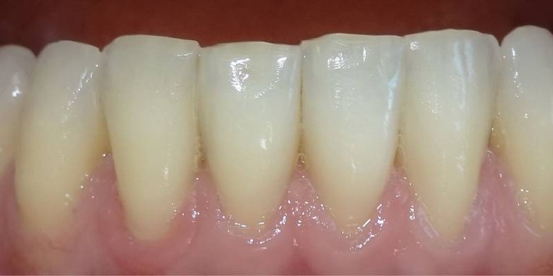 Después de hacer el tratamiento de ortodoncia invisible y rehabilitación estética dental