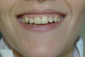 Abans tractament Periodontal i Rehabilitació prostética