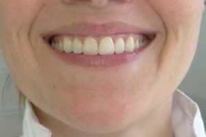 Después del tratamiento Periodontal y Rehabilitación prostética